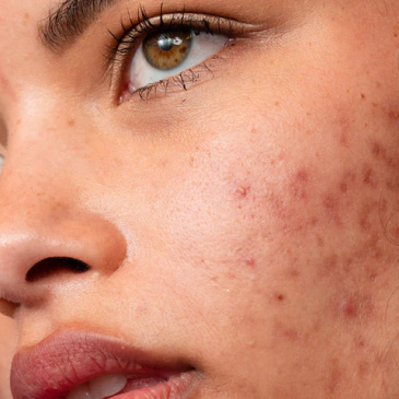 acne and breakouts